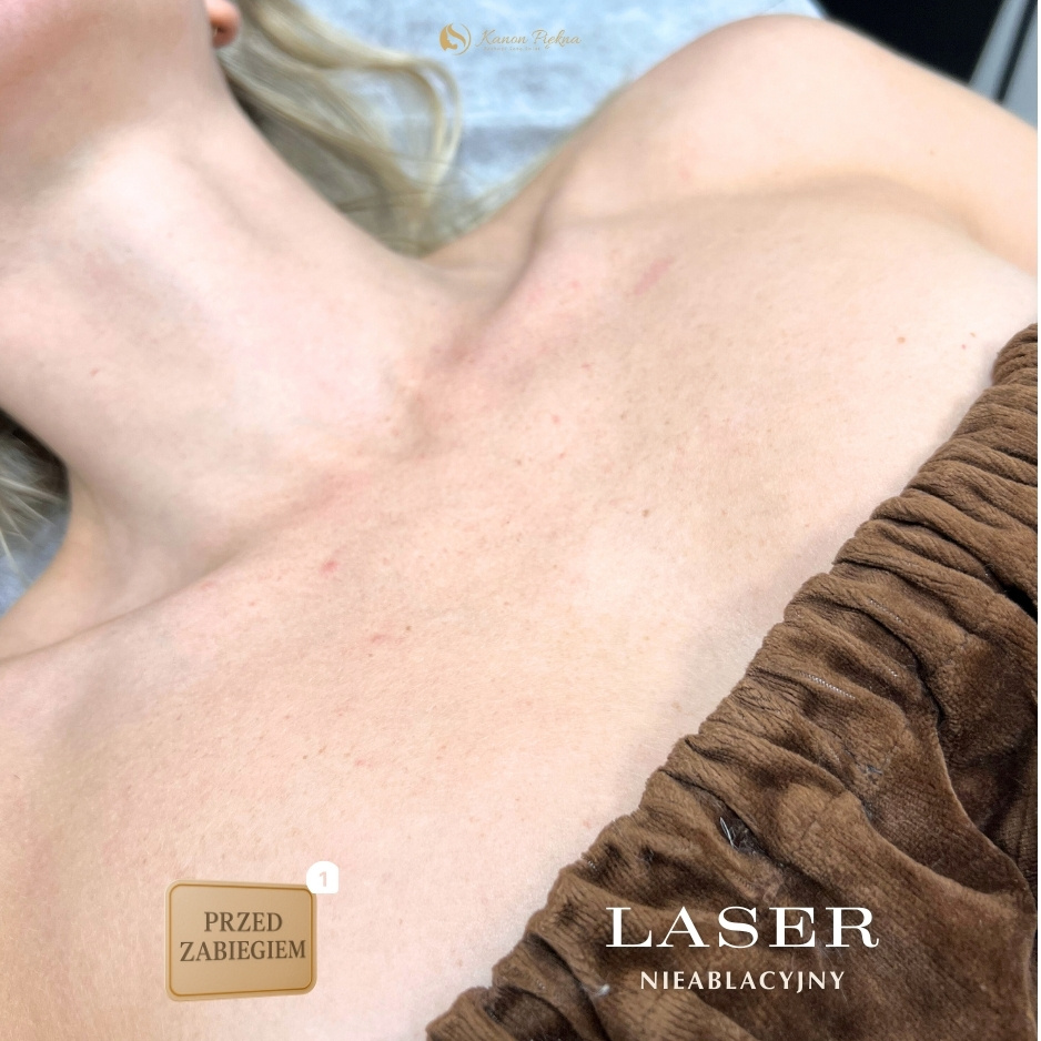 Bezpośrednio przed zabiegiem – świeży wygląd skóry
