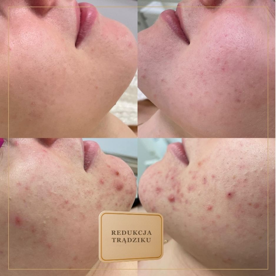 Po kilku tygodniach – lepsza gęstość i jędrność