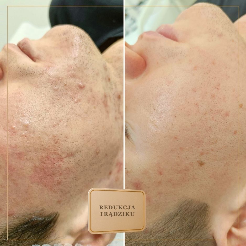 Po kilku tygodniach – lepsza gęstość i jędrność