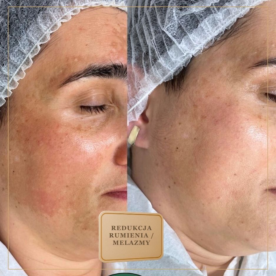 Bezpośrednio przed zabiegiem – świeży wygląd skóry