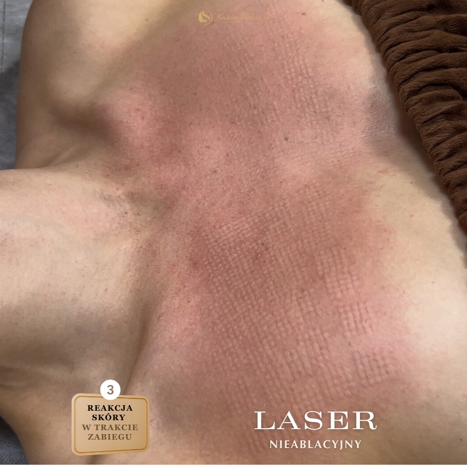 Po kilku tygodniach – lepsza gęstość i jędrność