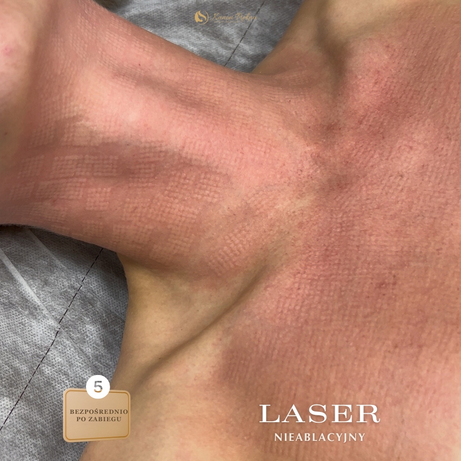 Po kilku tygodniach – lepsza gęstość i jędrność