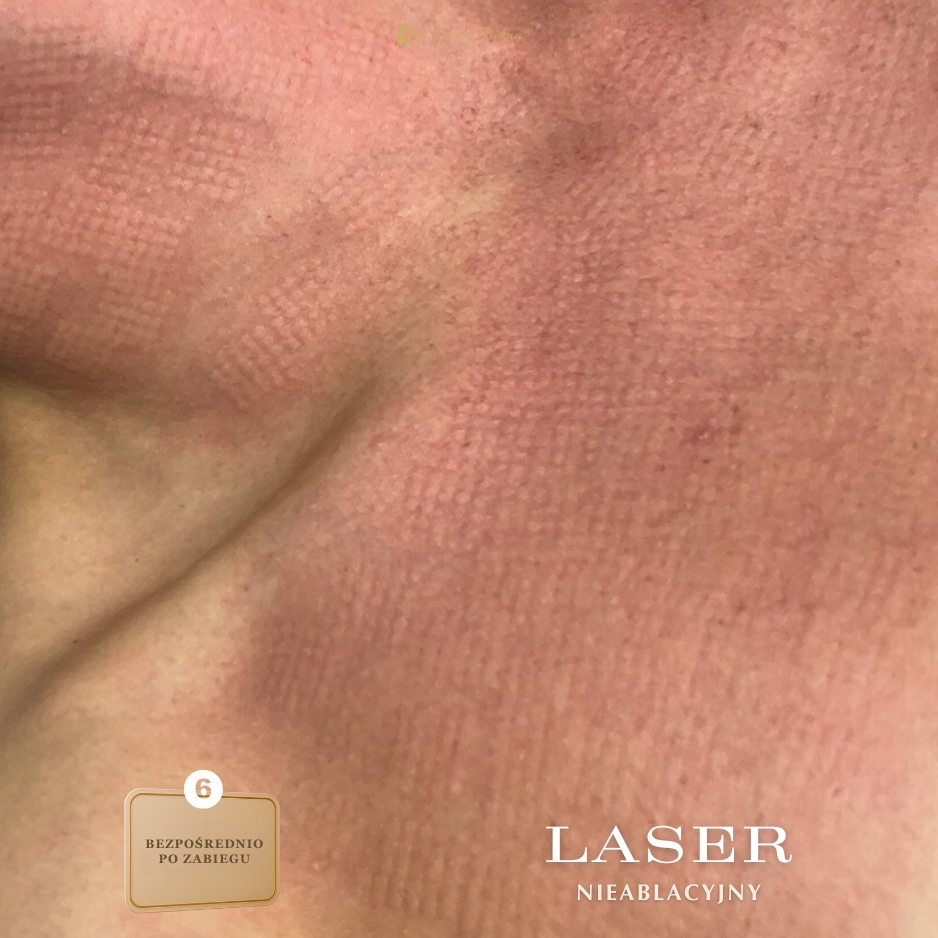 Po kilku tygodniach – lepsza gęstość i jędrność