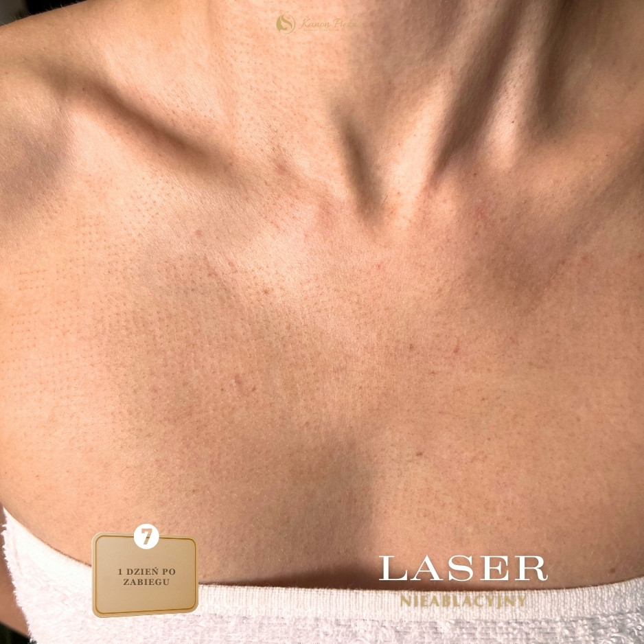 Po serii 3–4 zabiegów – utrwalenie efektu