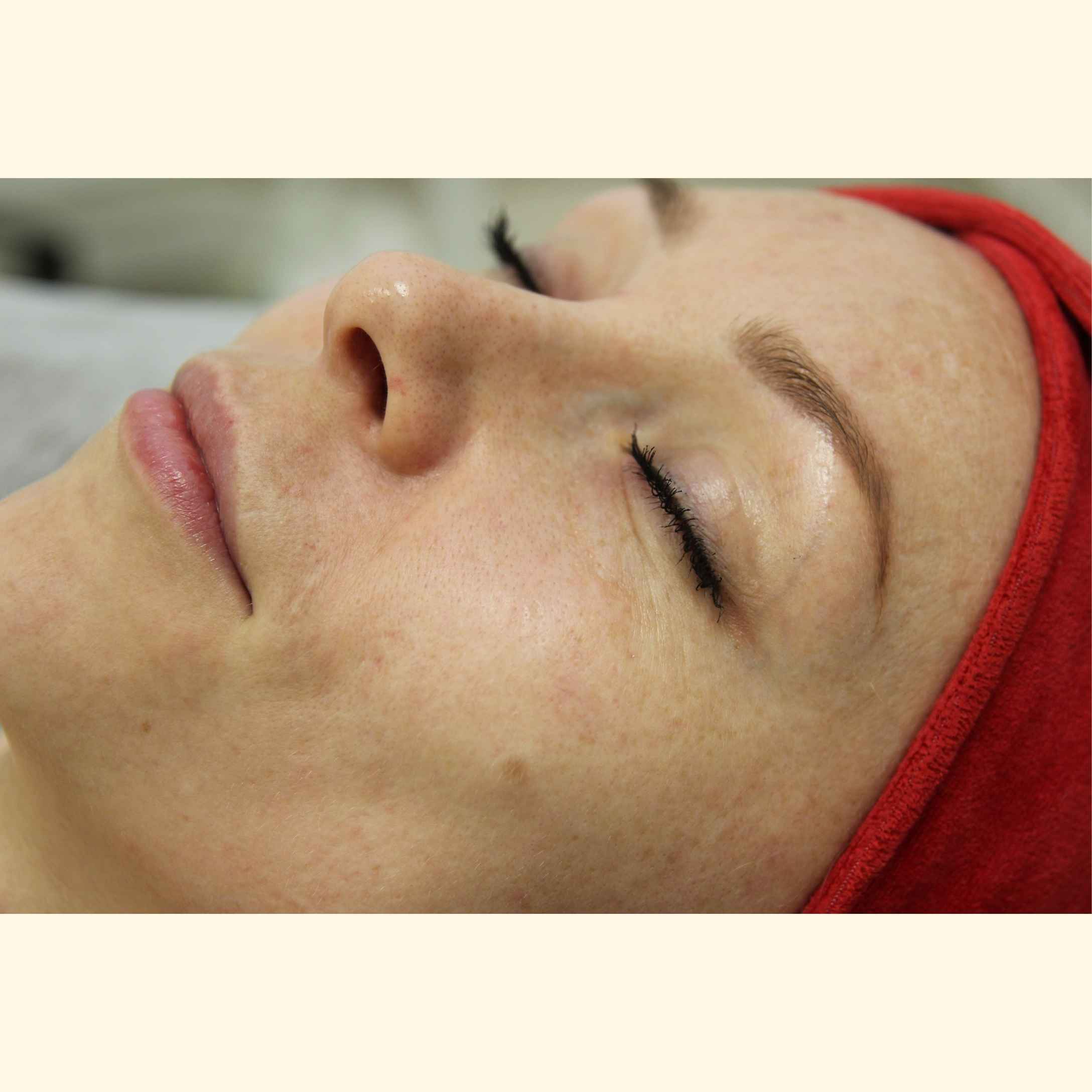 Bezpośrednio przed zabiegiem – świeży wygląd skóry