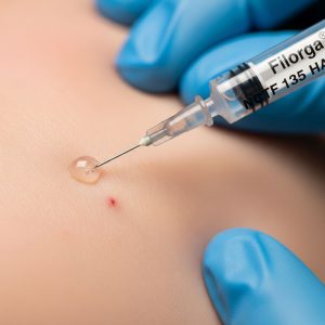 Mezoterapia Igłowa Filorga NCTF 135 Ha NOWY SĄCZ